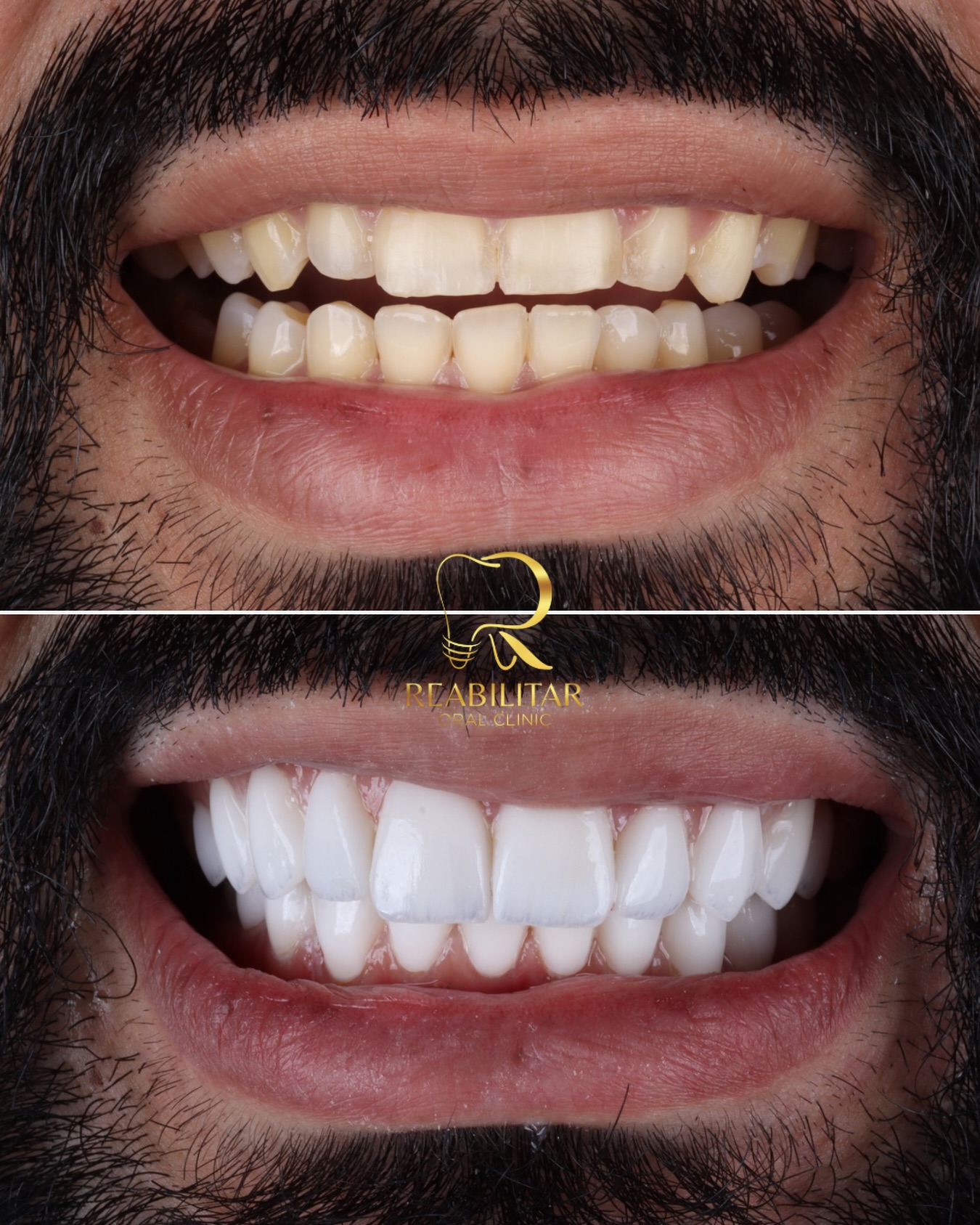 Comparativo antes e depois de um caso com lentes de porcelana nos dentes superiores e inferiores.