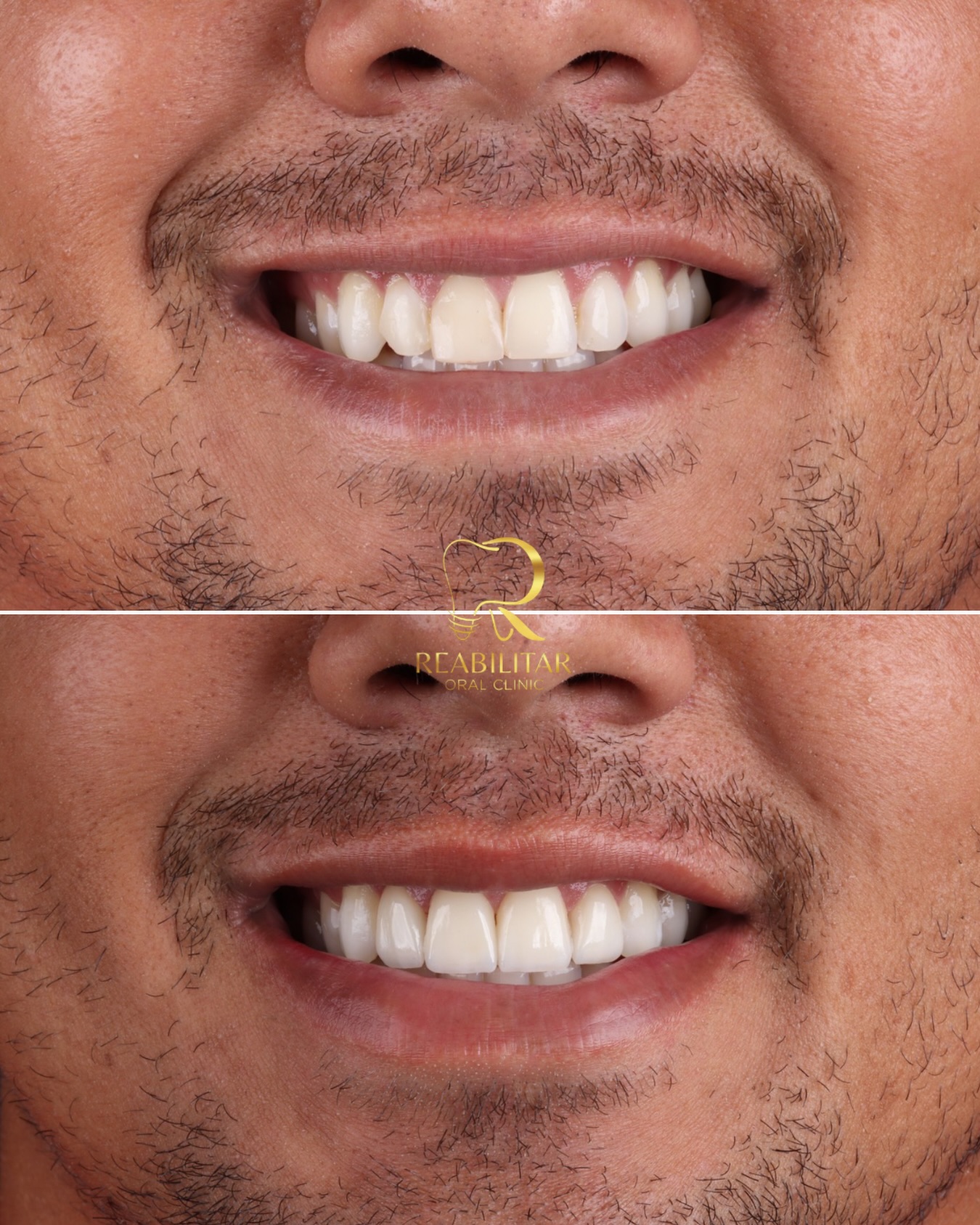 Comparativo antes e depois de lentes de porcelana nos dentes superiores.