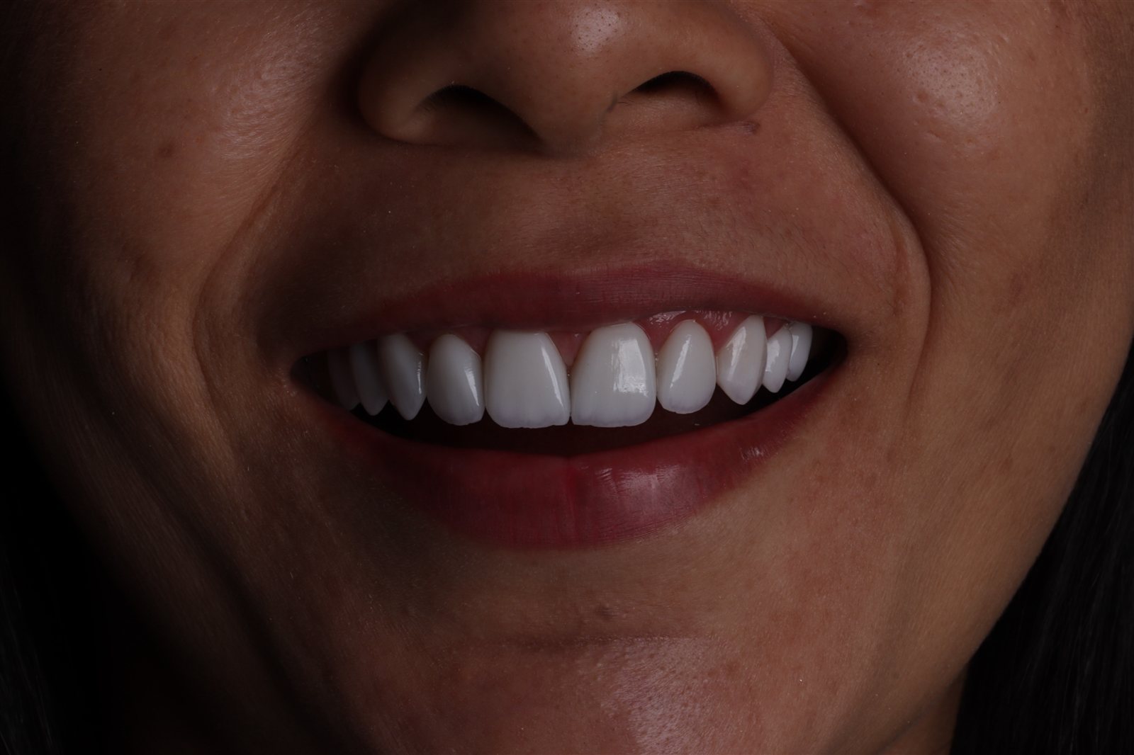 Detalhe do sorriso após a instalação de lentes de porcelana.