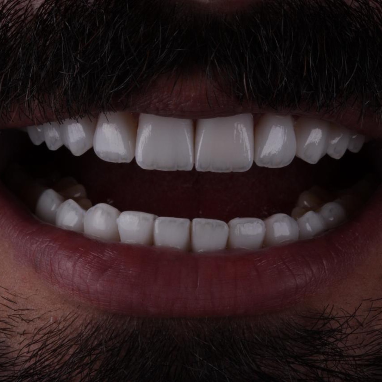 Detalhe de textura e brilho de lentes de porcelana.